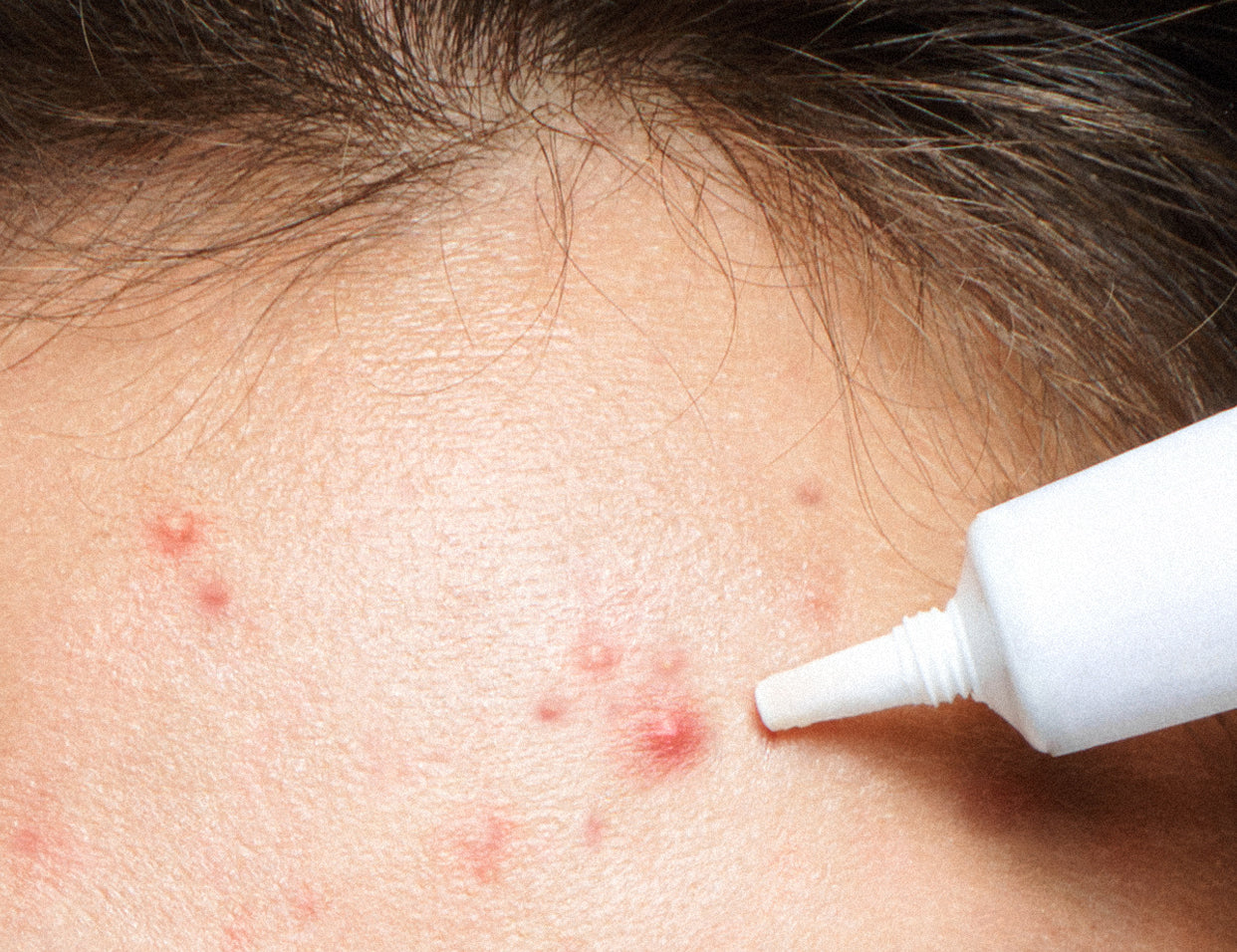 cosmetic ingredients for acne