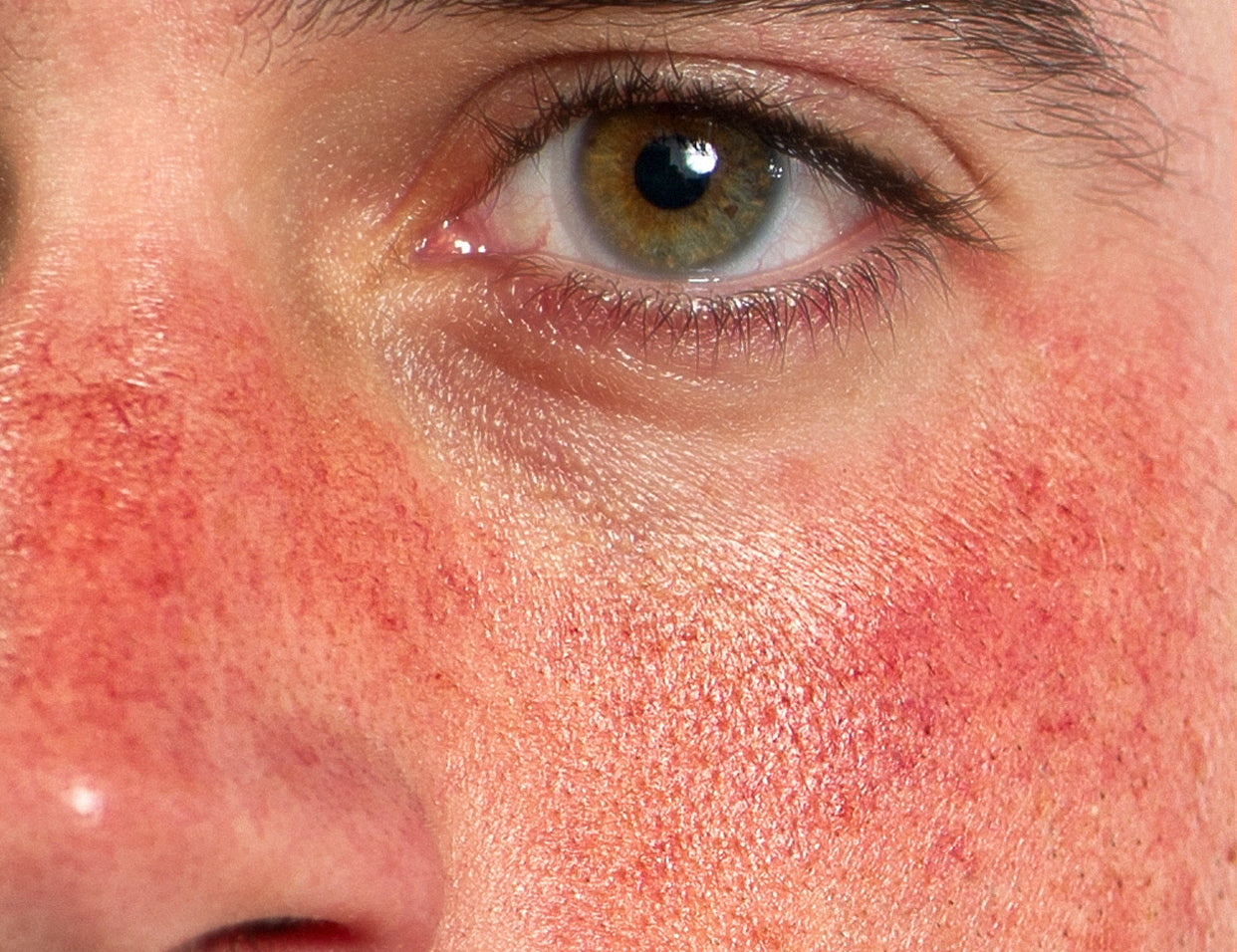 skincare that helps rosacea